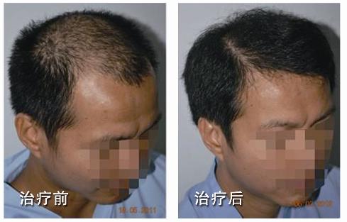 斑秃的治疗前后对比