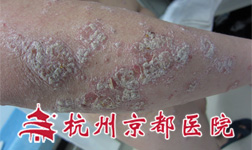 温州华医堂皮肤病专科治疗牛皮癣